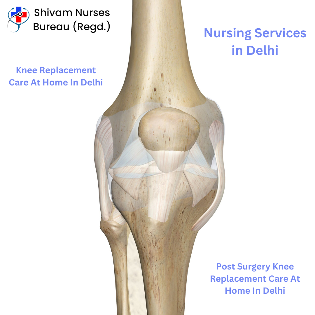 Knee replacement care at home in delhi post surgery care